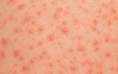 पित्ती (Hives) क्या है? इसका लक्षण, कारण, बचाव और इलाज